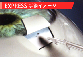 EXPRESS手術イメージ