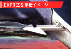 EXPRESS手術イメージ